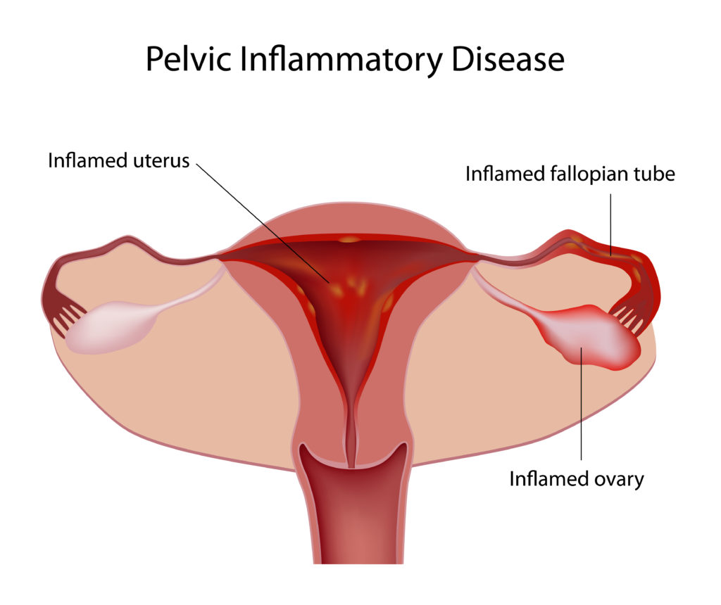 Maladie inflammatoire pelvienne